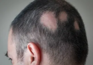 Alopecia Areata
