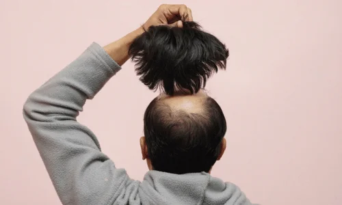 Cosmetic Hair Systems